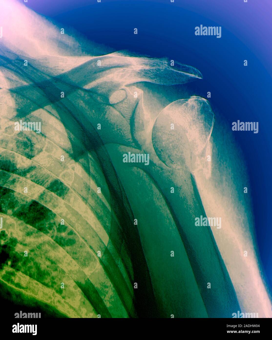 Broken upper arm bone. Coloured Xray of the left shoulder of a patient