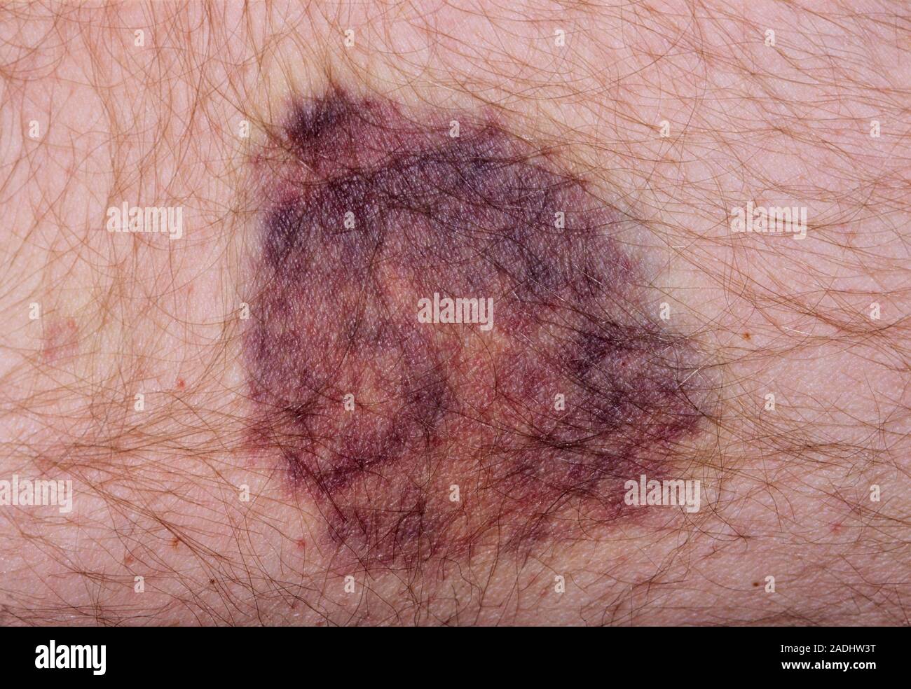 Spontaneous bruising in a 70yearold male taking aspirin and