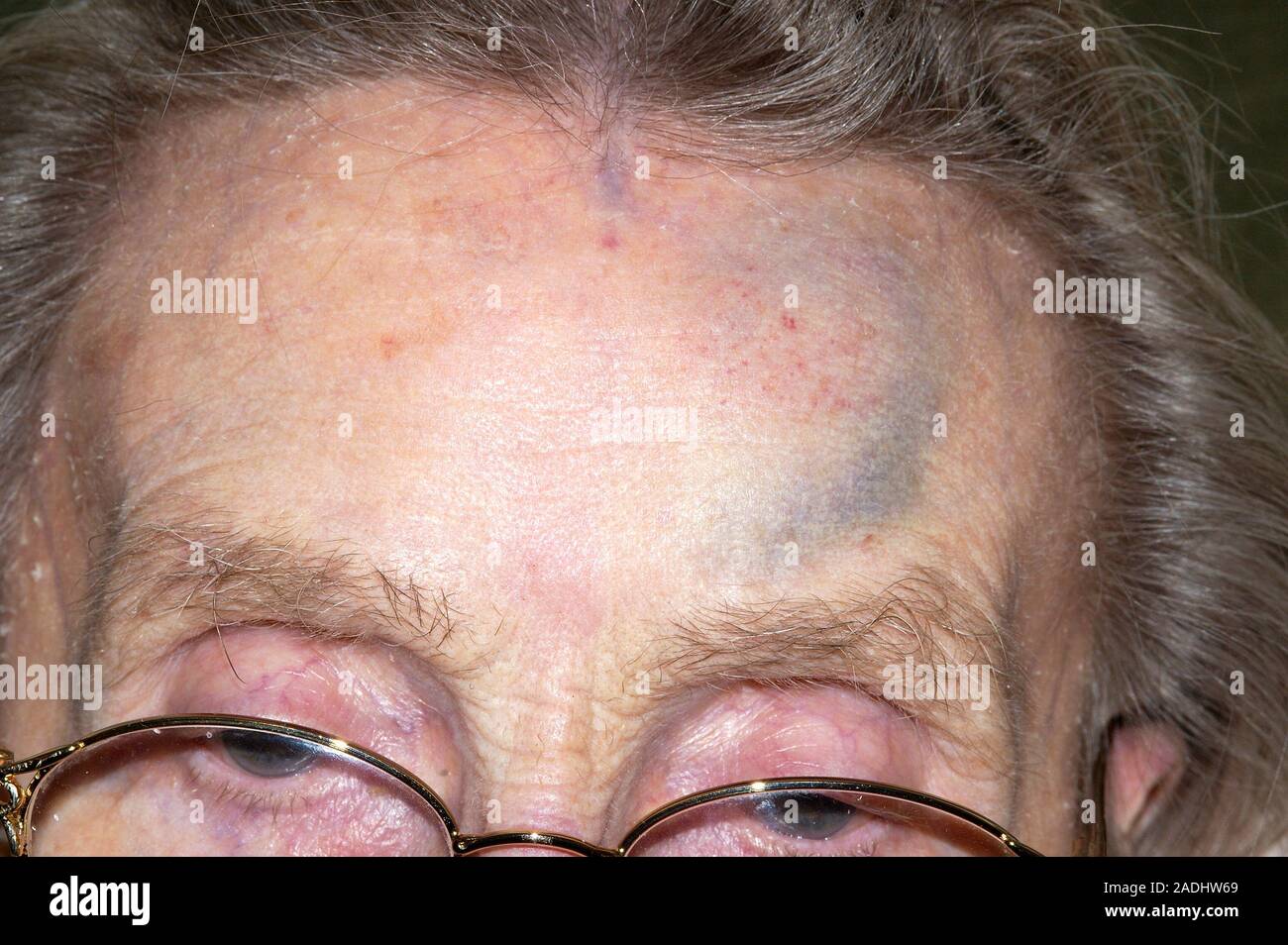 Bruised forehead of a 90-year-old woman following a fall. The ...