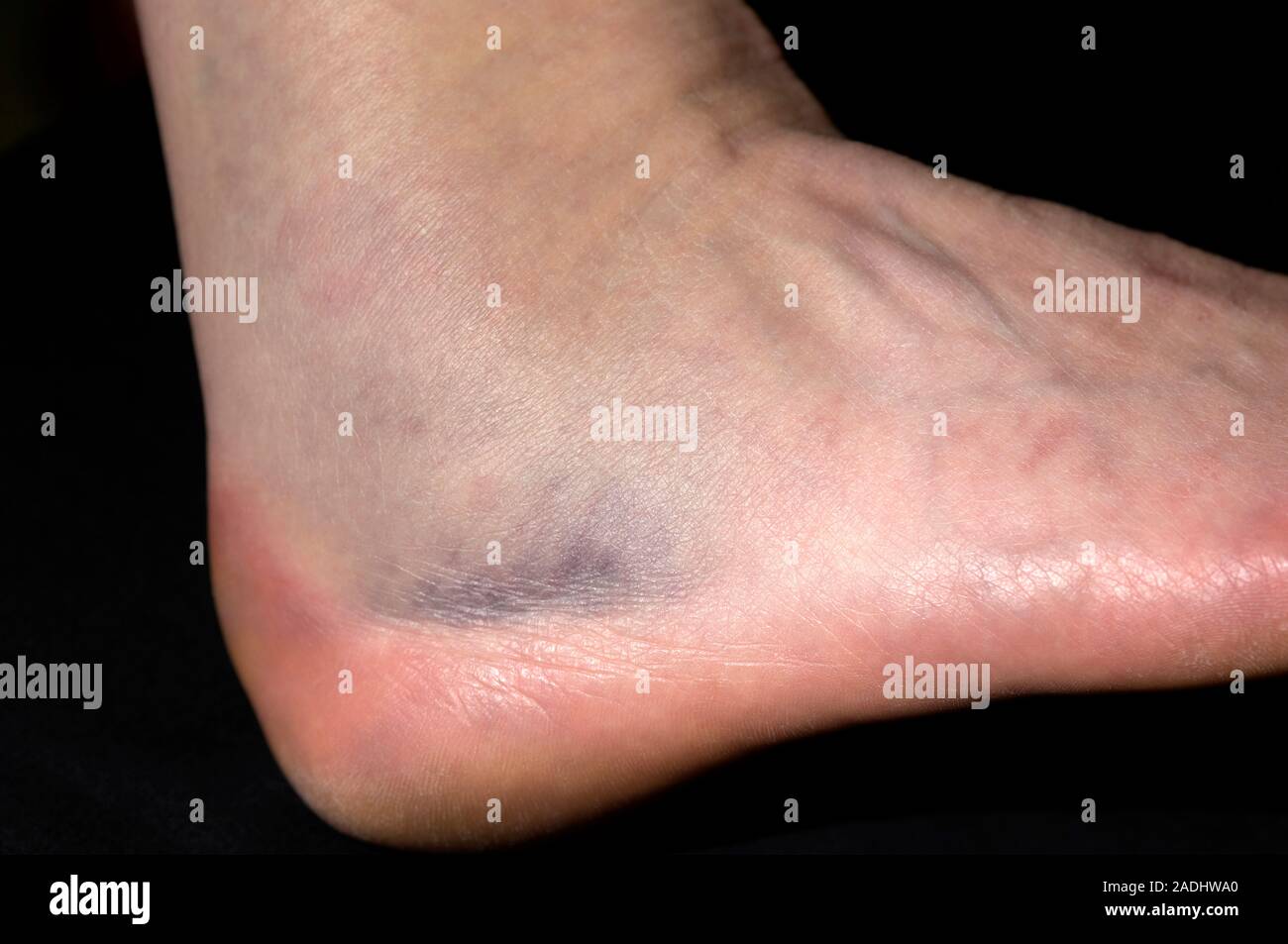 Fractured ankle bone, with bruising (black), on a 44yearold woman's