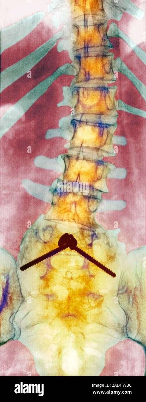 Pinned curved spine. Coloured Xray of bones of the spine and pelvis of