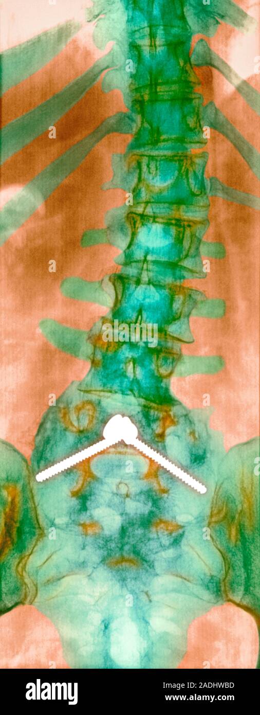 Pinned curved spine. Coloured Xray of bones of the spine and pelvis of