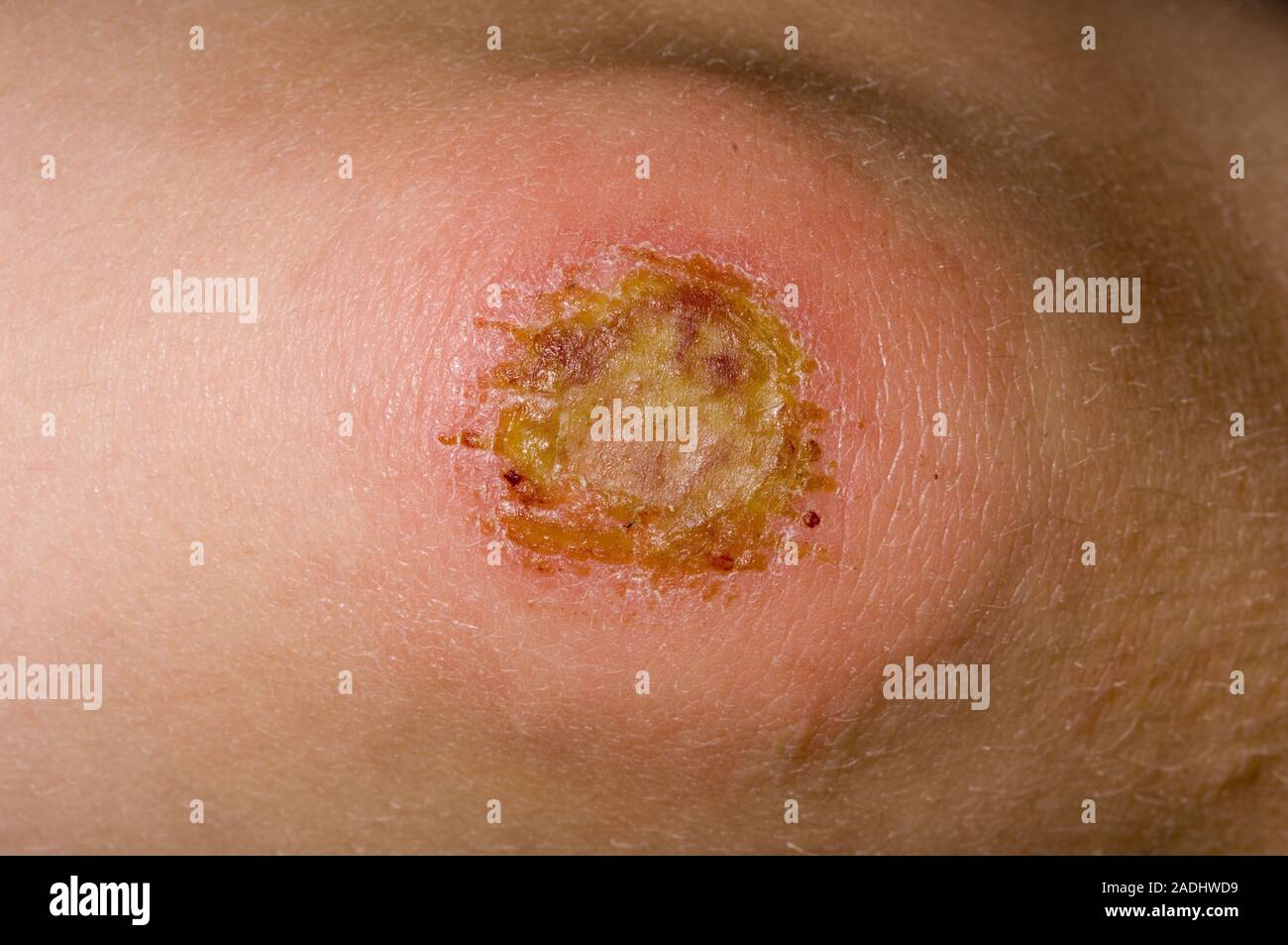 MODEL RELEASED. Infected cut on the knee of a 5 year old girl