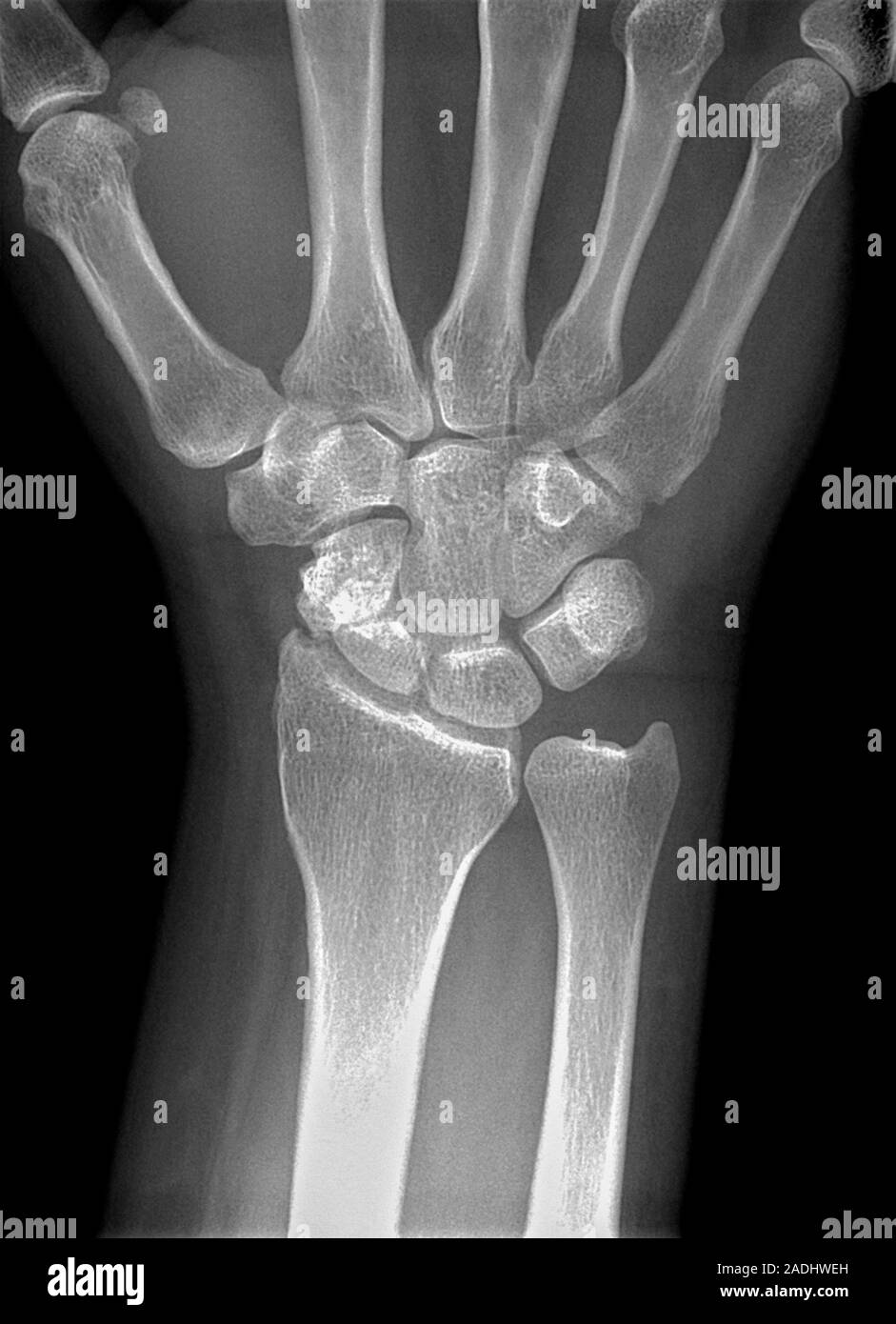 Broken wrist. Xray of the hand of a patient with a fractured scaphoid