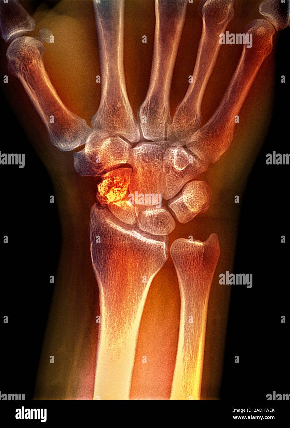 Broken wrist. Coloured X-ray of the hand of a patient with a fractured  scaphoid bone (bright orange) that has failed to heal. The scaphoid bone is  one Stock Photo - Alamy