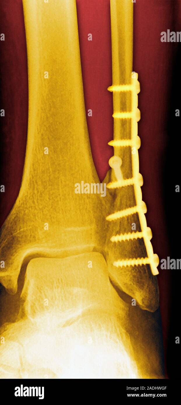 Pinned Ankle Fracture. Coloured X-ray Of The Ankle Bones Of A Patient 