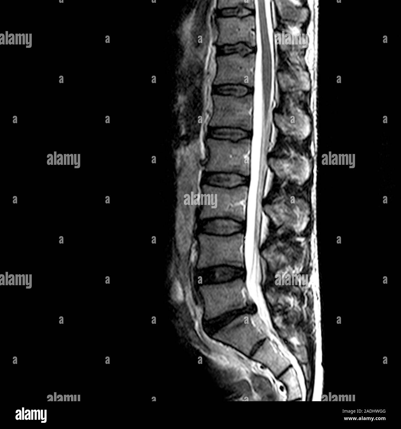 Slipped disc. resonance imaging (MRI) scan of the lower spine