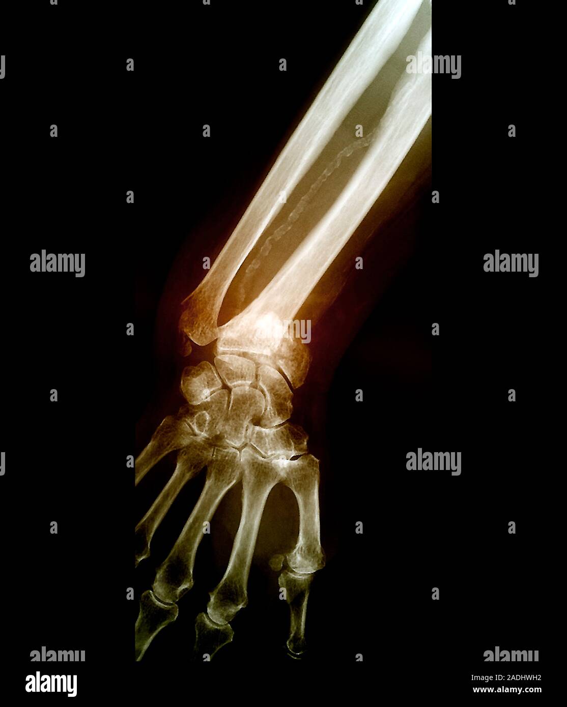 Colles' wrist fracture. Coloured frontal Xray of the hand and wrist
