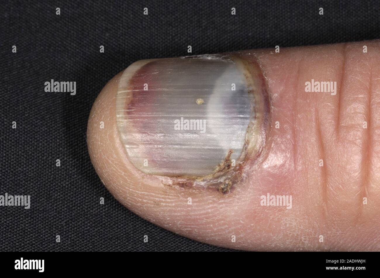 Bruised fingernail. Blood under the fingernail of a 56 year old man, 7