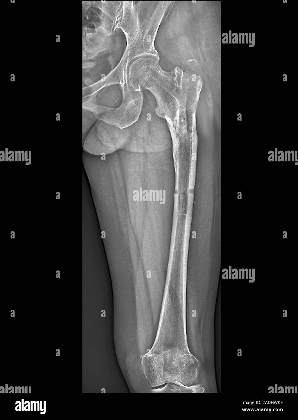 Broken leg. Frontal X-ray of the fractured left femur (thigh bone) of a  56-year-old man. The fracture is seen running across the bone at centre  right Stock Photo - Alamy, image size:985x1390