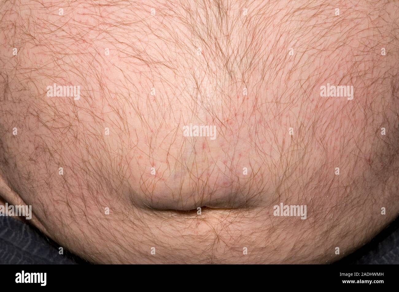 Umbilical (navel) Hernias ~ & Other Midline Hernias - The British