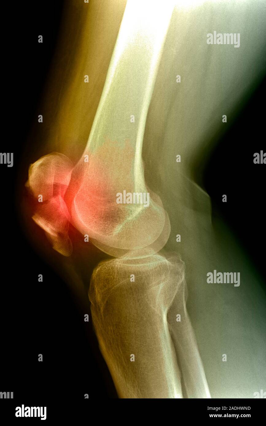 Kneecap fracture. Coloured Xray of a broken kneecap (patella), as viewed from the side. The