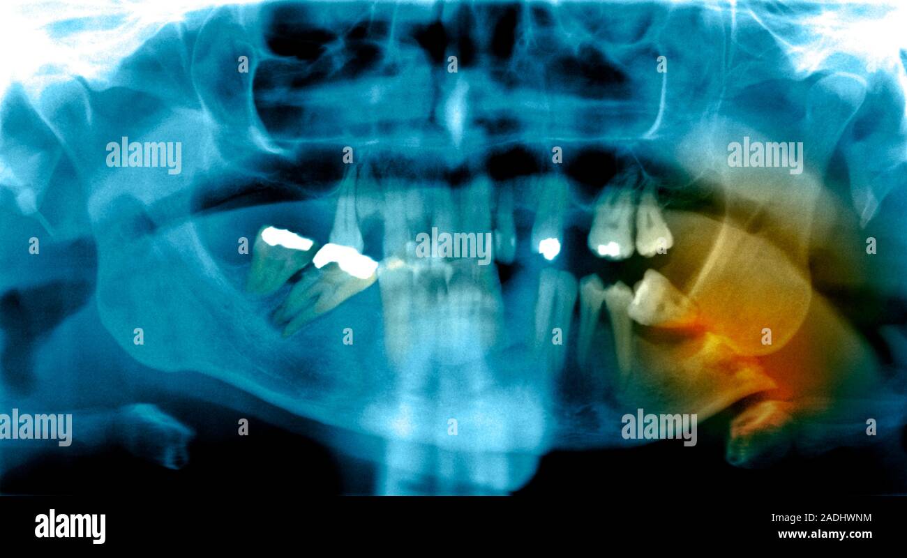Fractured jawbone. Coloured Xray of a human jaw showing a fractured
