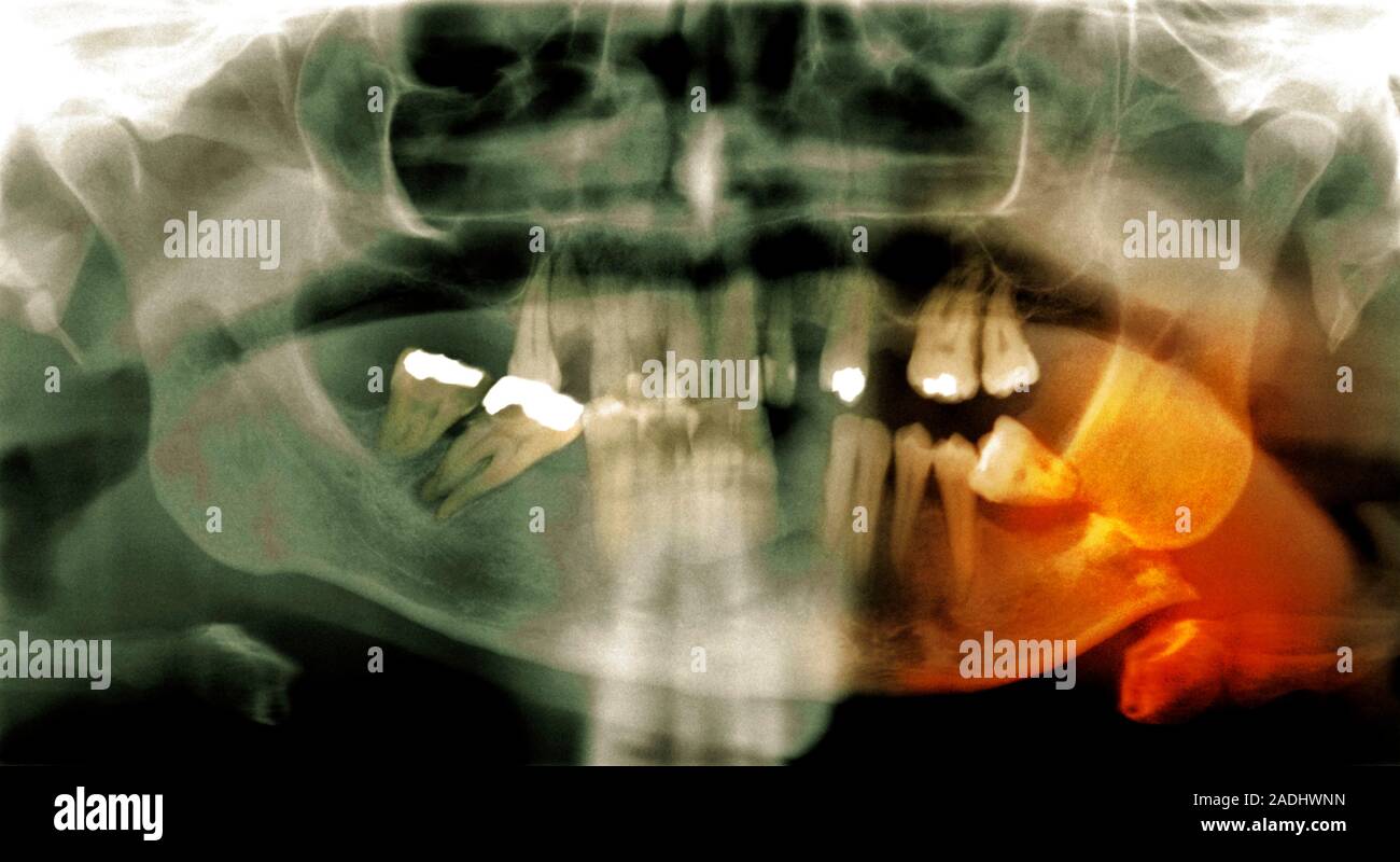 Fractured jawbone. Coloured Xray of a human jaw showing a fractured