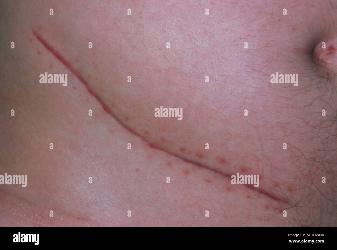 Appendicectomy scar on the abdomen of a patient. Appendicectomy, the