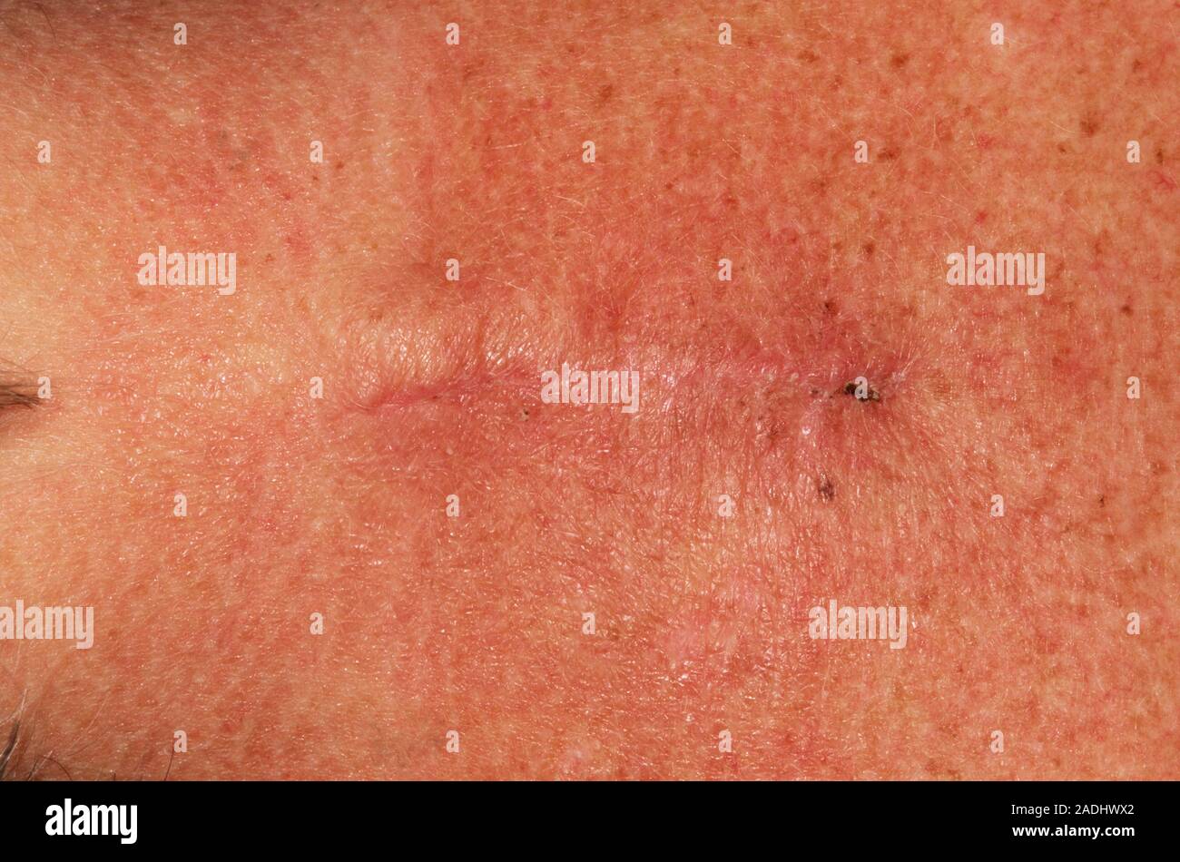 Disc surgery scar. Scar on the back of a 42year old woman, two weeks