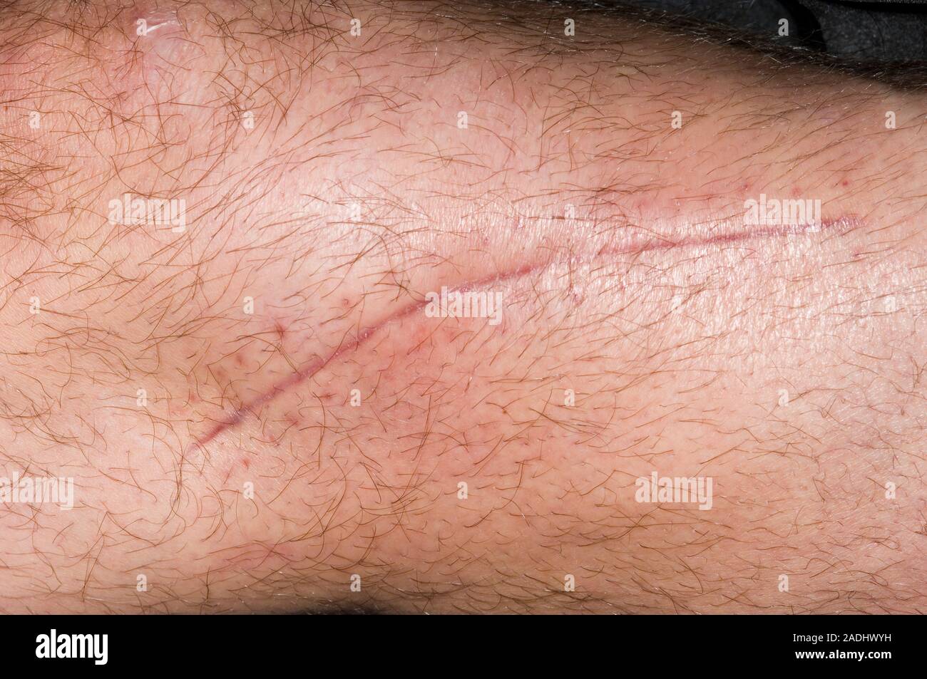 MODEL RELEASED. Scar on a fractured leg. Knee of a 56 year old man