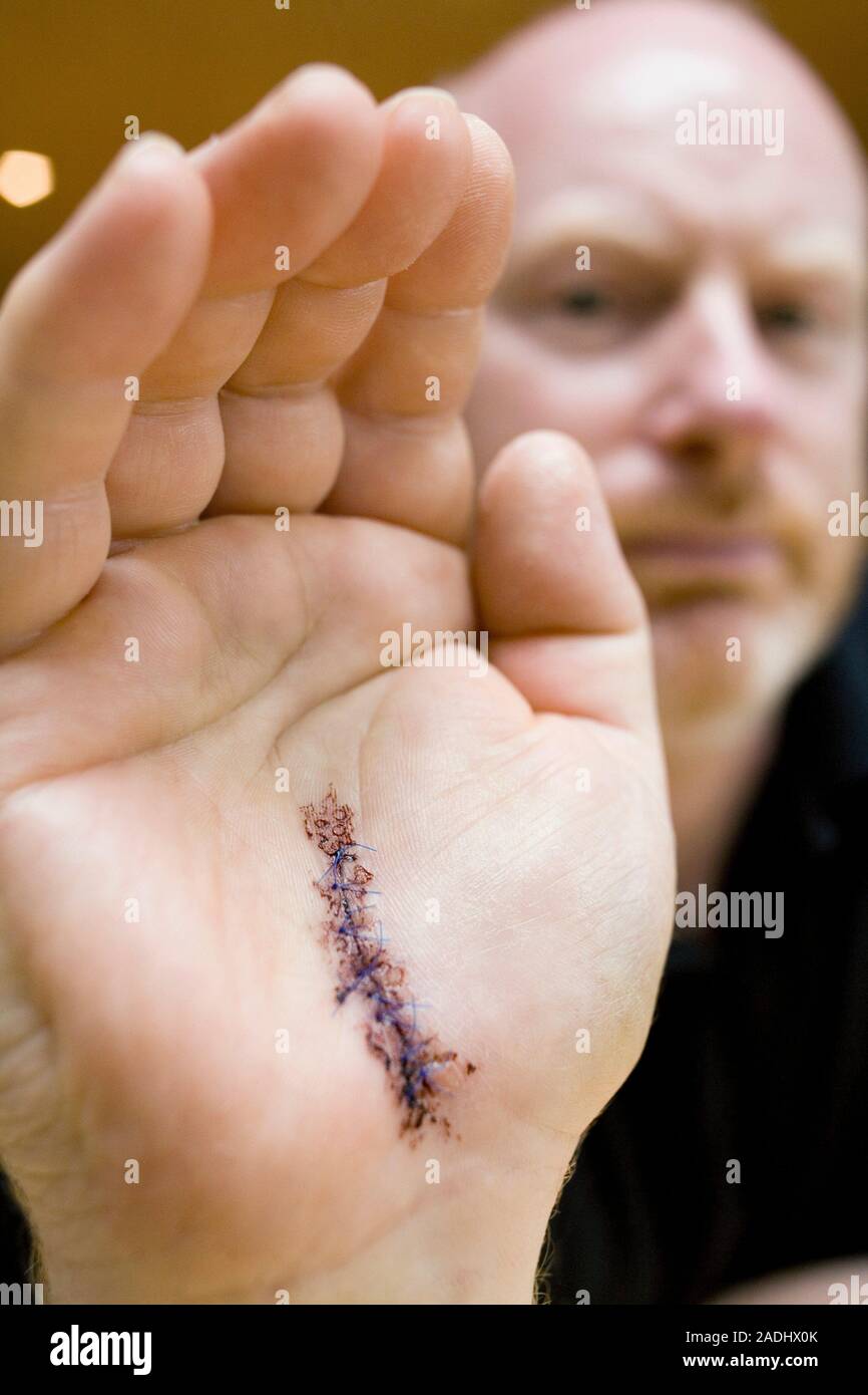 MODEL RELEASED. Surgical wound. Stitched wound on a man's hand after