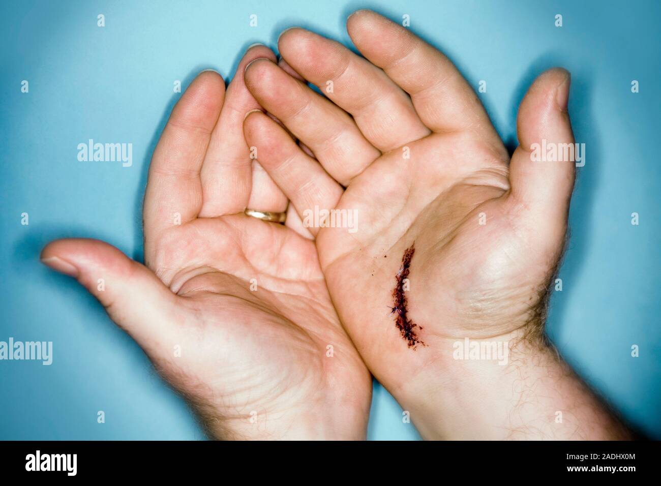 MODEL RELEASED. Surgical wound. Stitched wound on a man's hand after