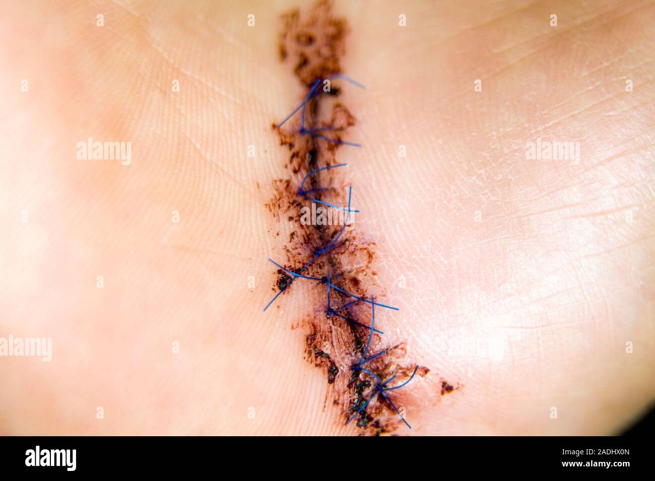 MODEL RELEASED. Surgical wound. Stitched wound on a man's hand after