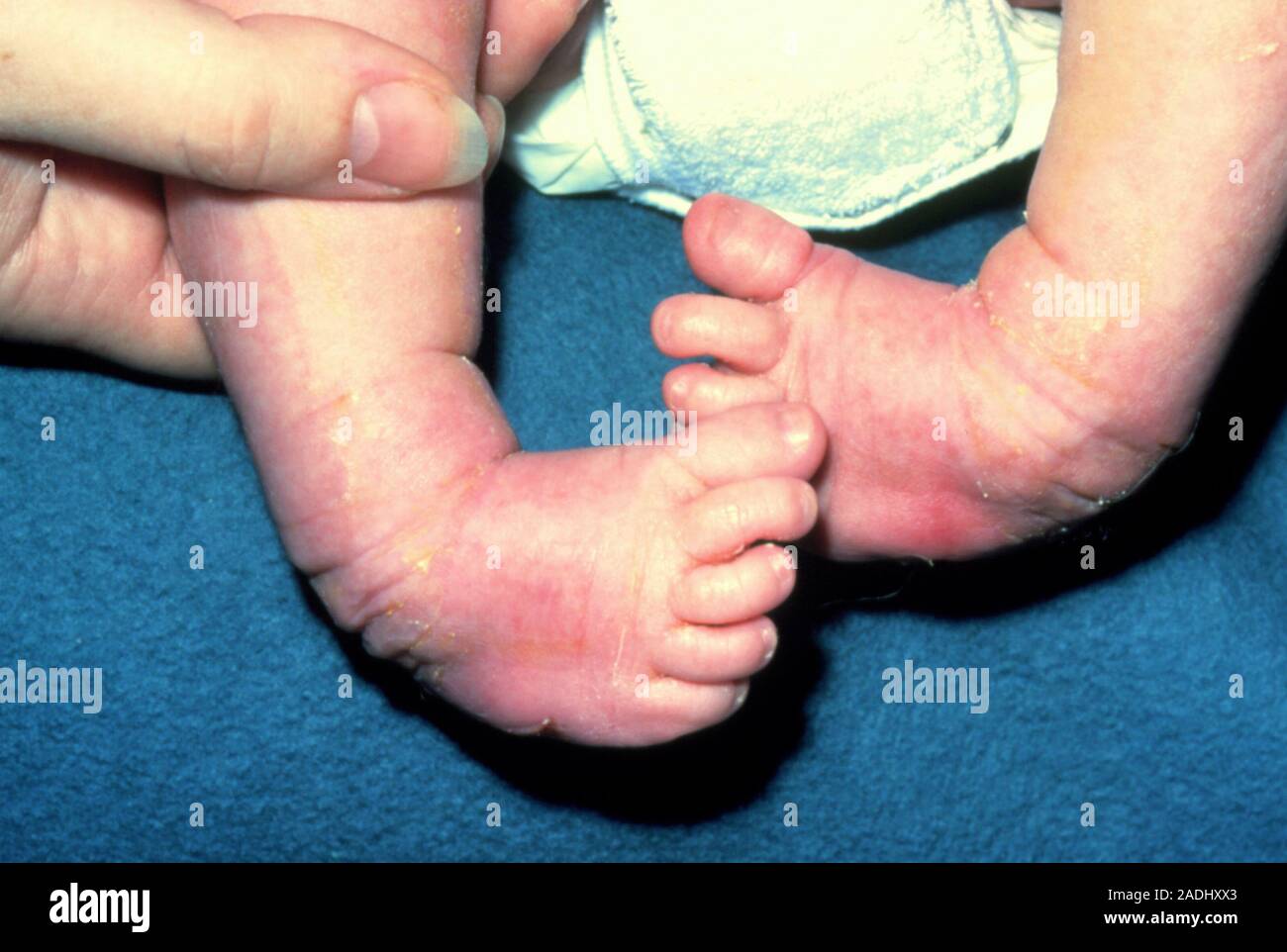 Newborn baby with club feet the most common variety talipes
