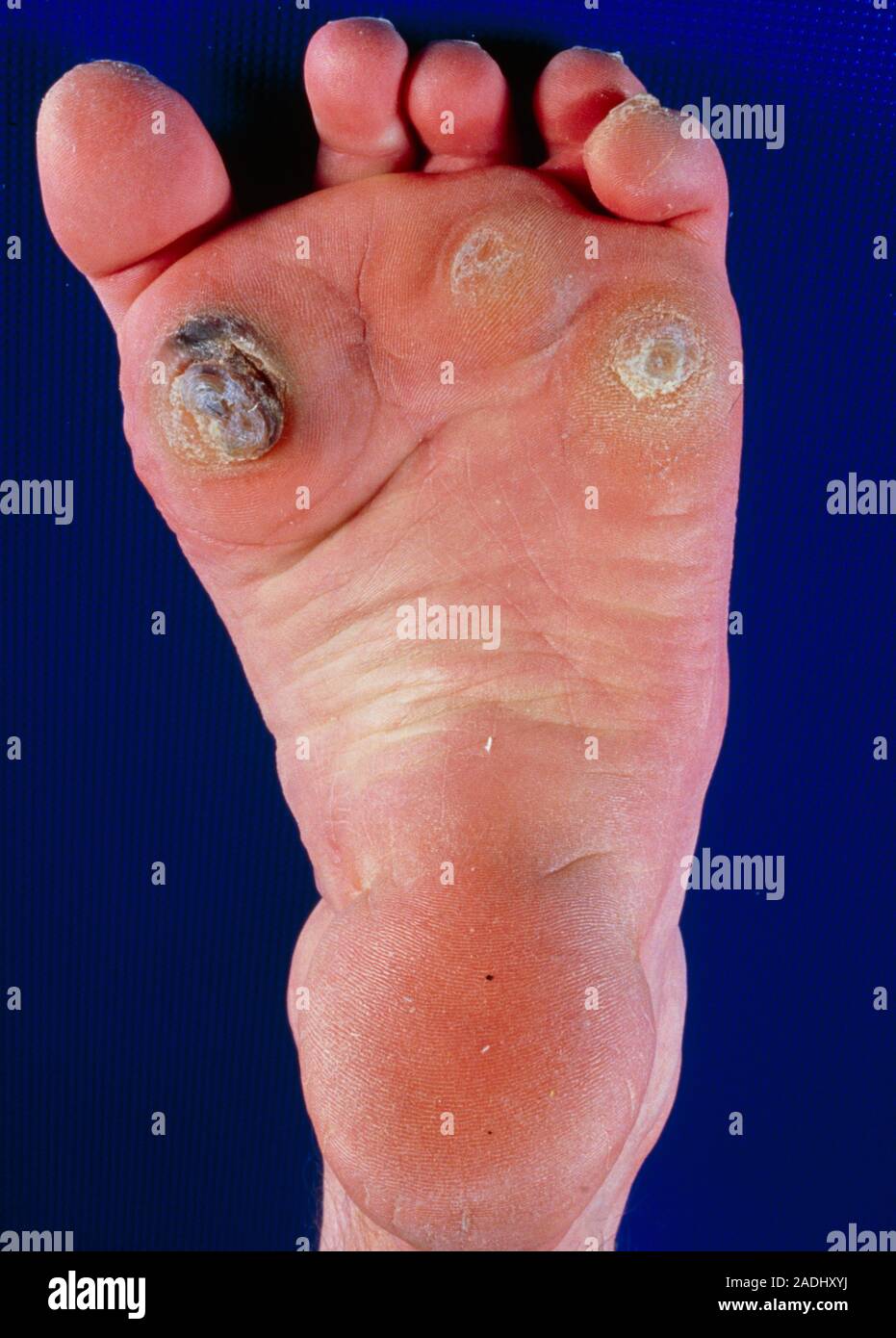 Clawtoes. The sole of the foot of a patient affected by claw toes at