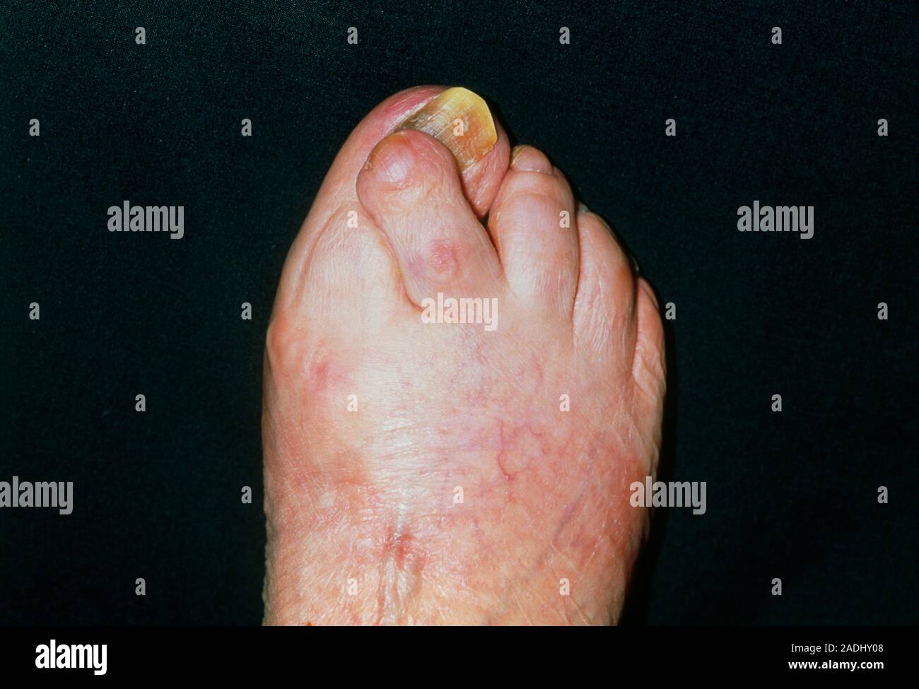 Hallux valgus. Inwardturning big toe and overriding second toe on the