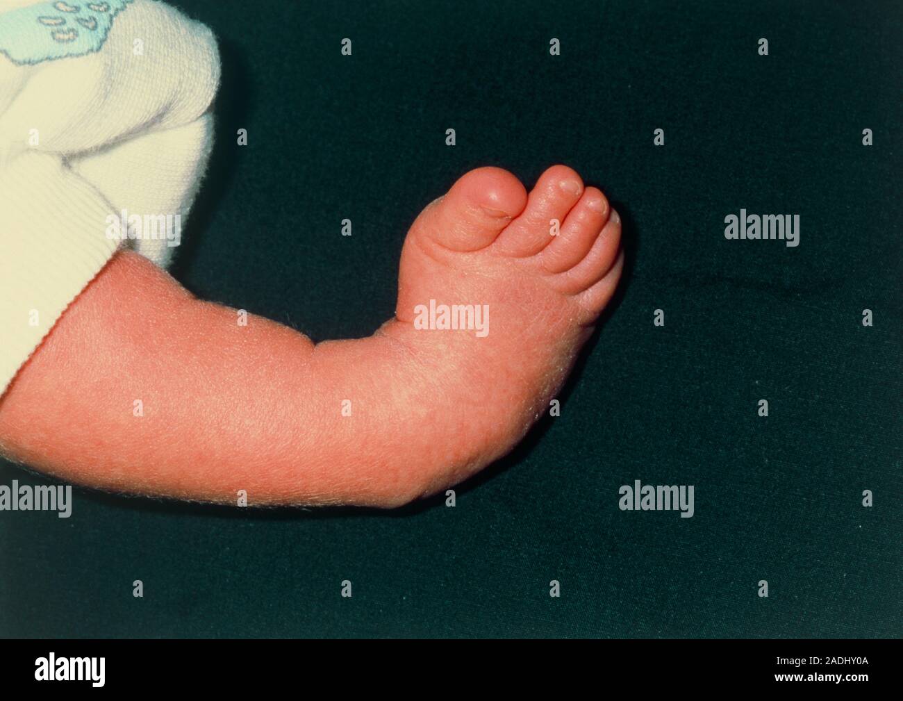 Club foot. Deformed foot of a 1 month old baby boy due to the
