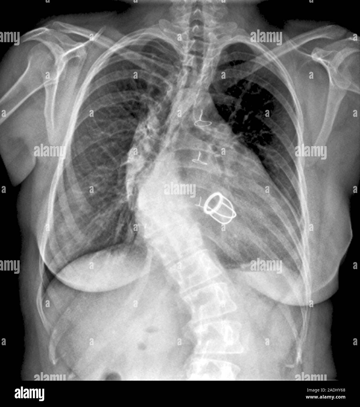Kyphoscoliosis. Frontal Xray image of the spine of a 35yearold woman