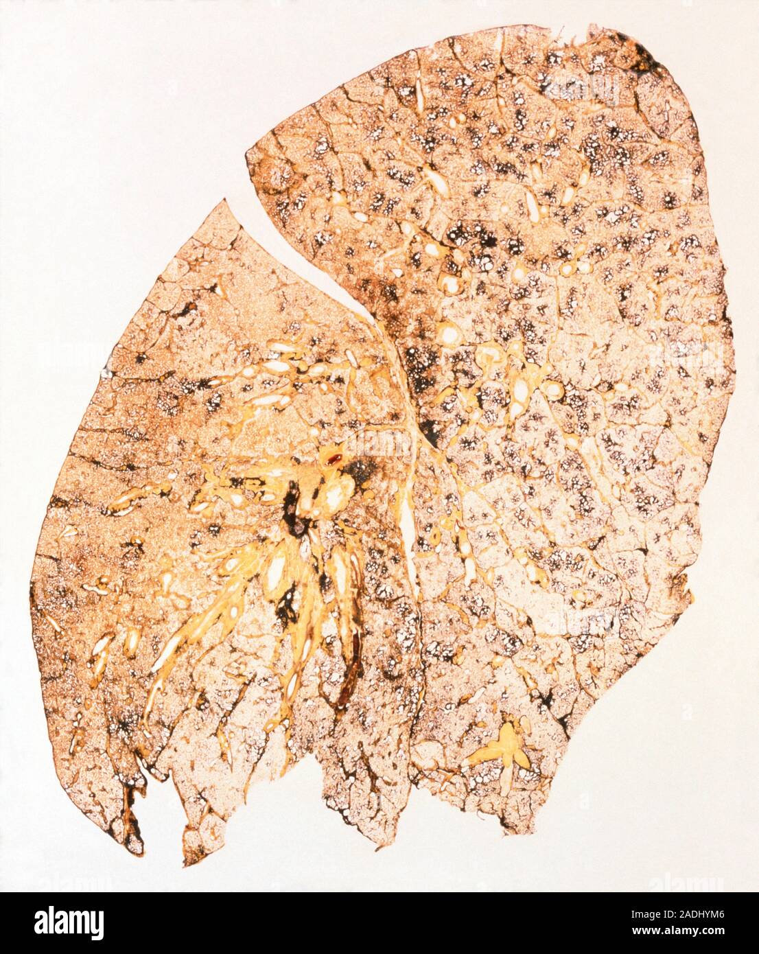 Силикоз кт. Болезнь силикоз. Обструктивные и рестриктивные заболевания легких патанатомия. Силикоз 1 стадия рентген. Болезнь силикоз.