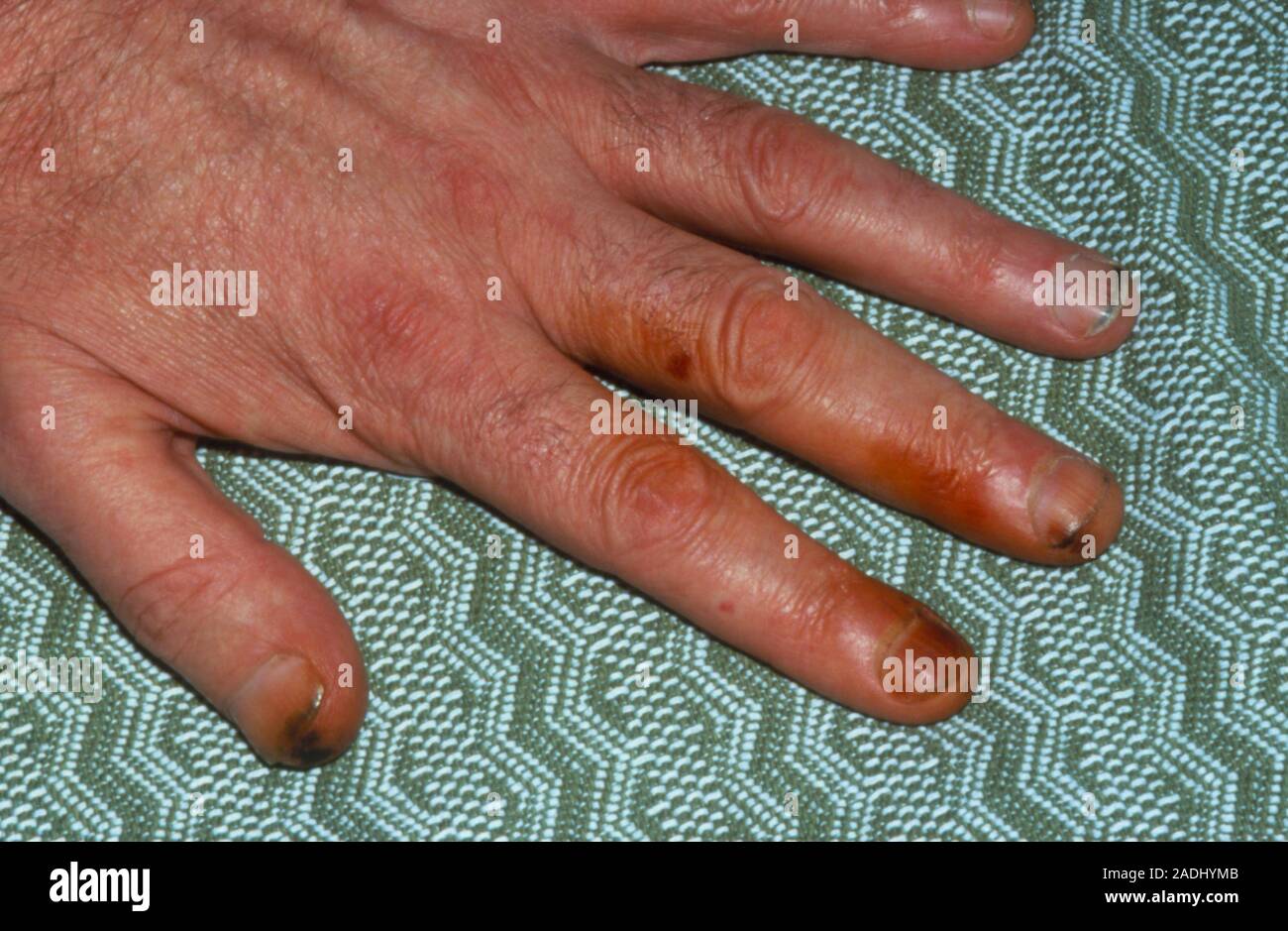 how do you get rid of tobacco stains on fingers Photograph of a hand showing extensive tar stains on the fingers and thumb,  caused by cigarette smoking Stock Photo