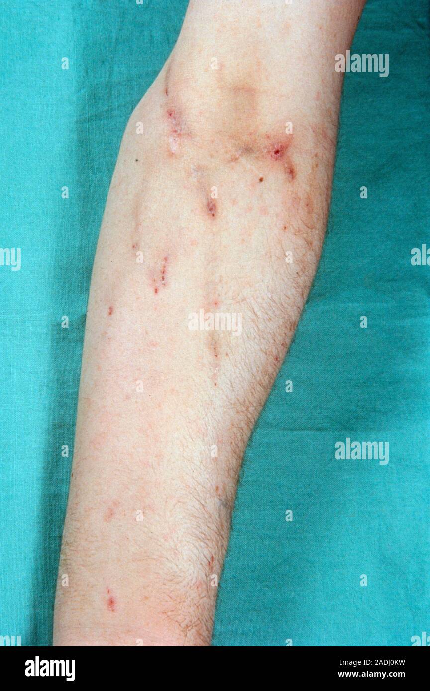 Track marks" scarred injection sites on the forearm of an intravenous