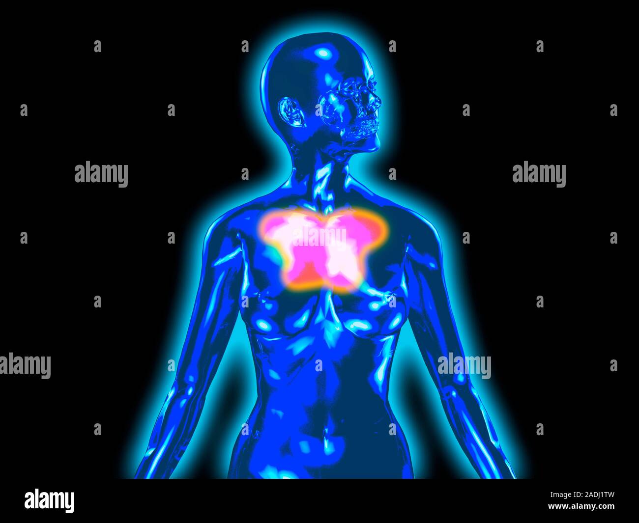 Chest pain. Conceptual computer artwork of chest pain, shown as red. This could represent