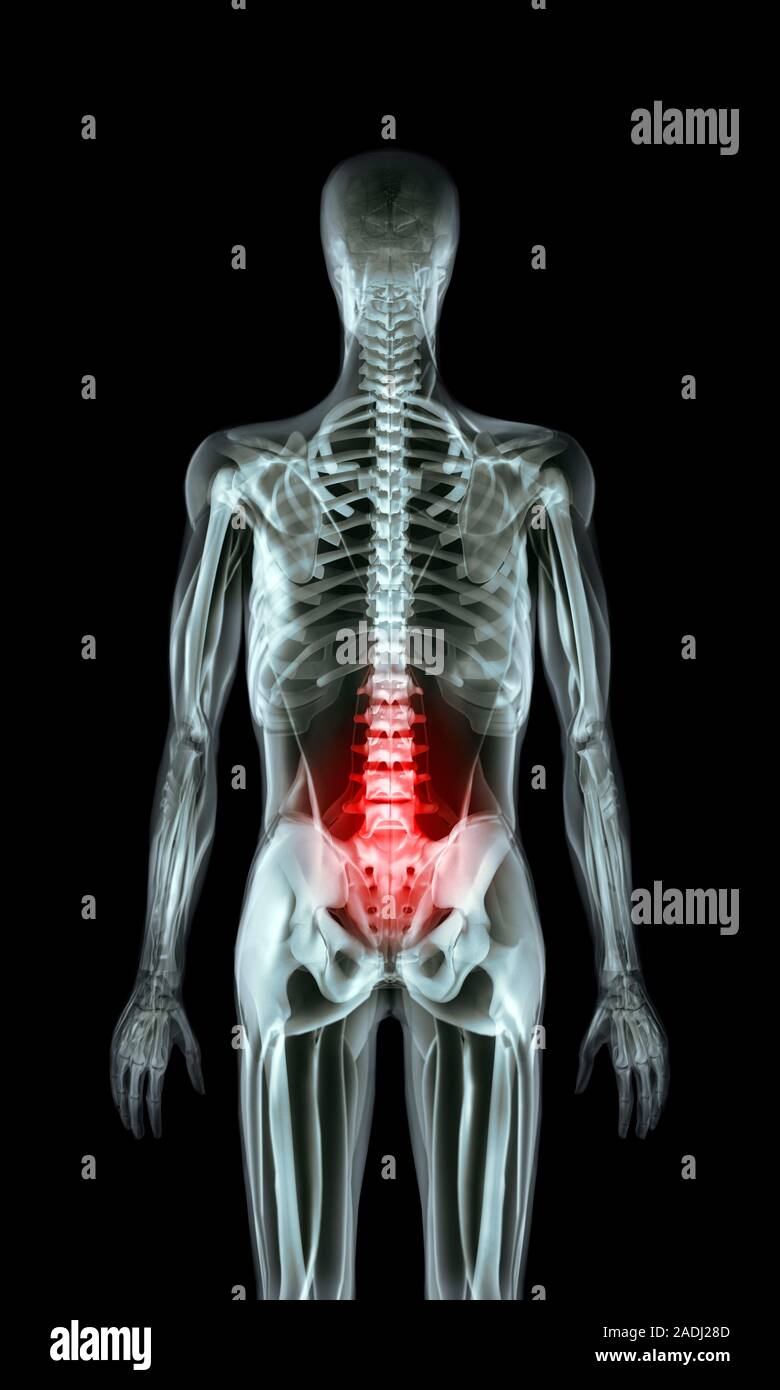 Back pain. Xray artwork of the rear view of a human skeleton. The red