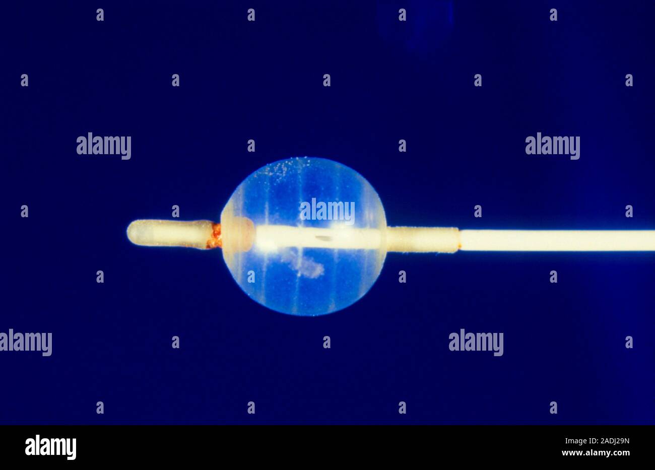 Fogarty embolic catheter, a ballooncarrying catheter used to remove an