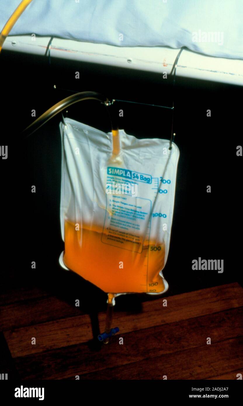 Plastic bag containing urine, suspended at the side of the bed of a patient undergoing urethral
