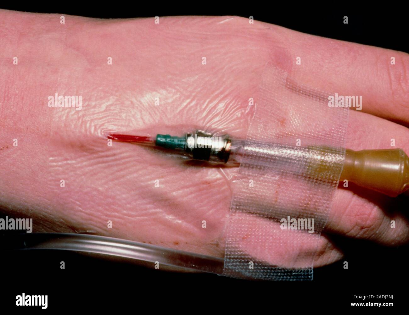 Intravenous catheter in hand. Patient's hand with an intravenous over