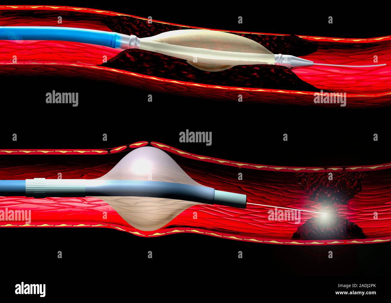 Angioplasty techniques. Computer illustration of balloon and laser