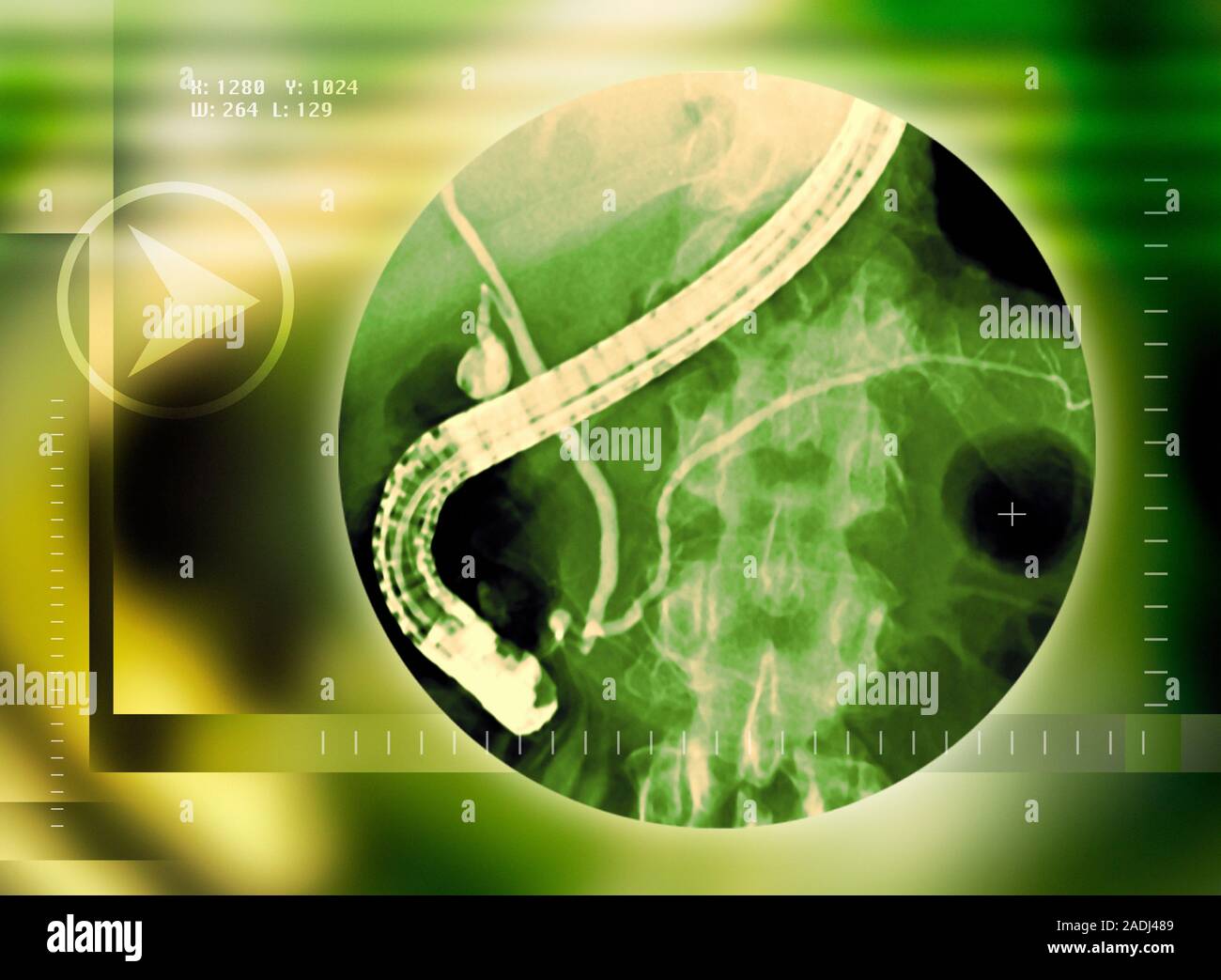 Endoscopic retrograde cholangiography (ERCP). This is a technique used ...