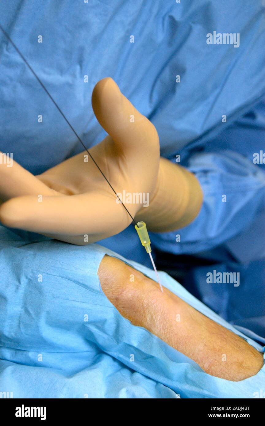 Coronary angiography. Surgeon inserting a wire catheter through a guide ...
