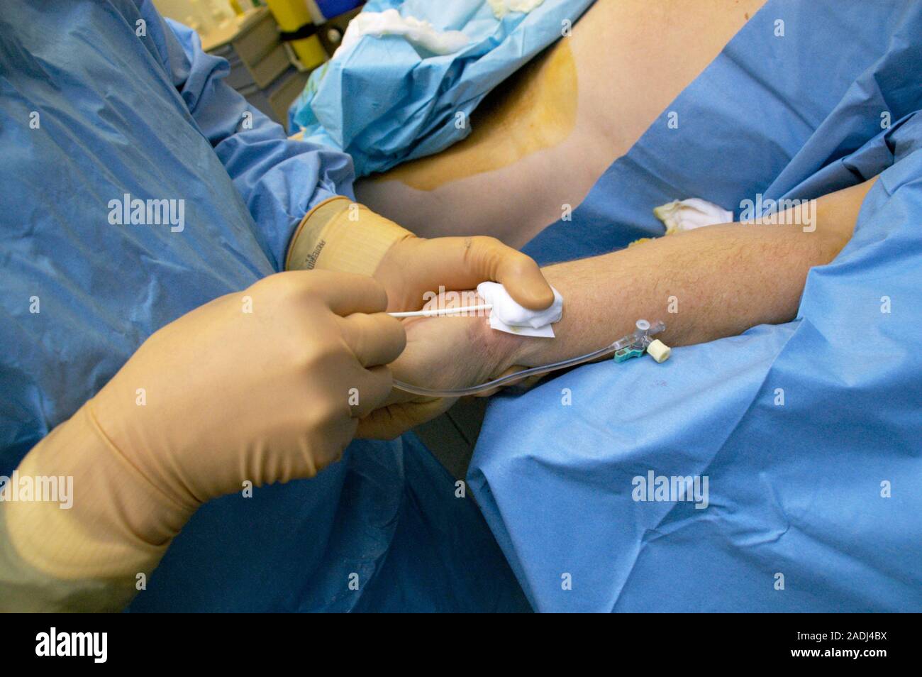 Coronary angiography. Surgeon removing a guide catheter from a 50-year ...