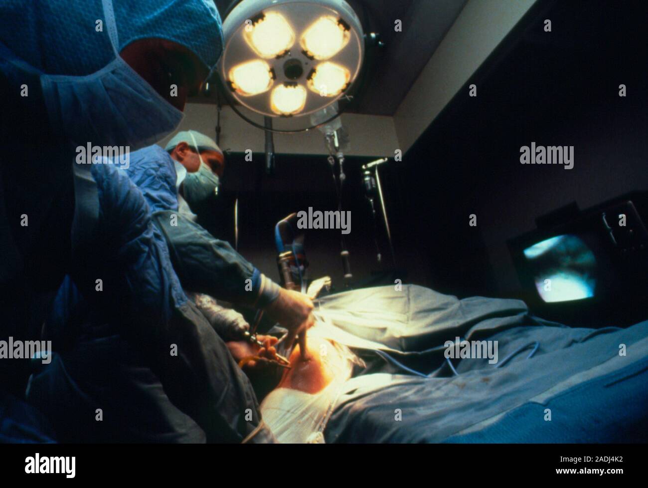 Arthroscopy minimallyinvasive (keyhole") surgery to remove damaged