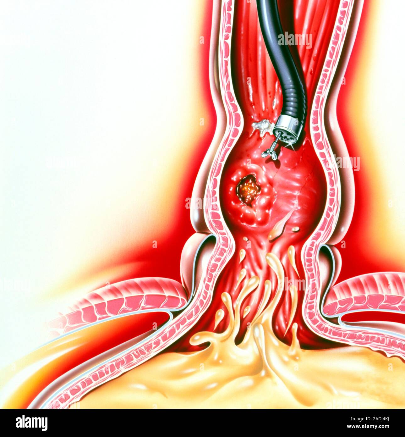 Endoscopic biopsy. Artwork of an endoscope (black) being used to remove ...