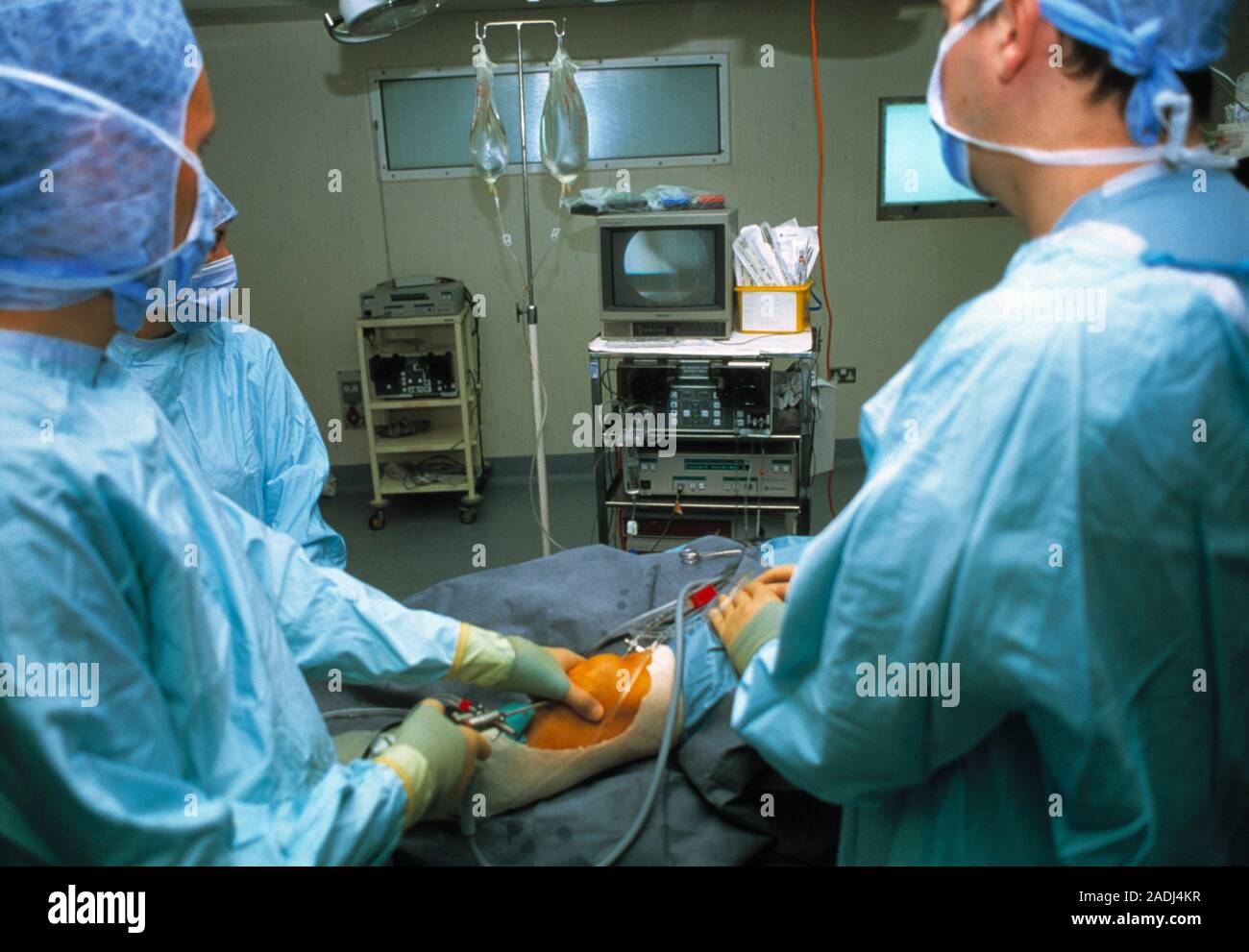 Knee arthroscopy. Surgeons performing arthroscopic removal of knee