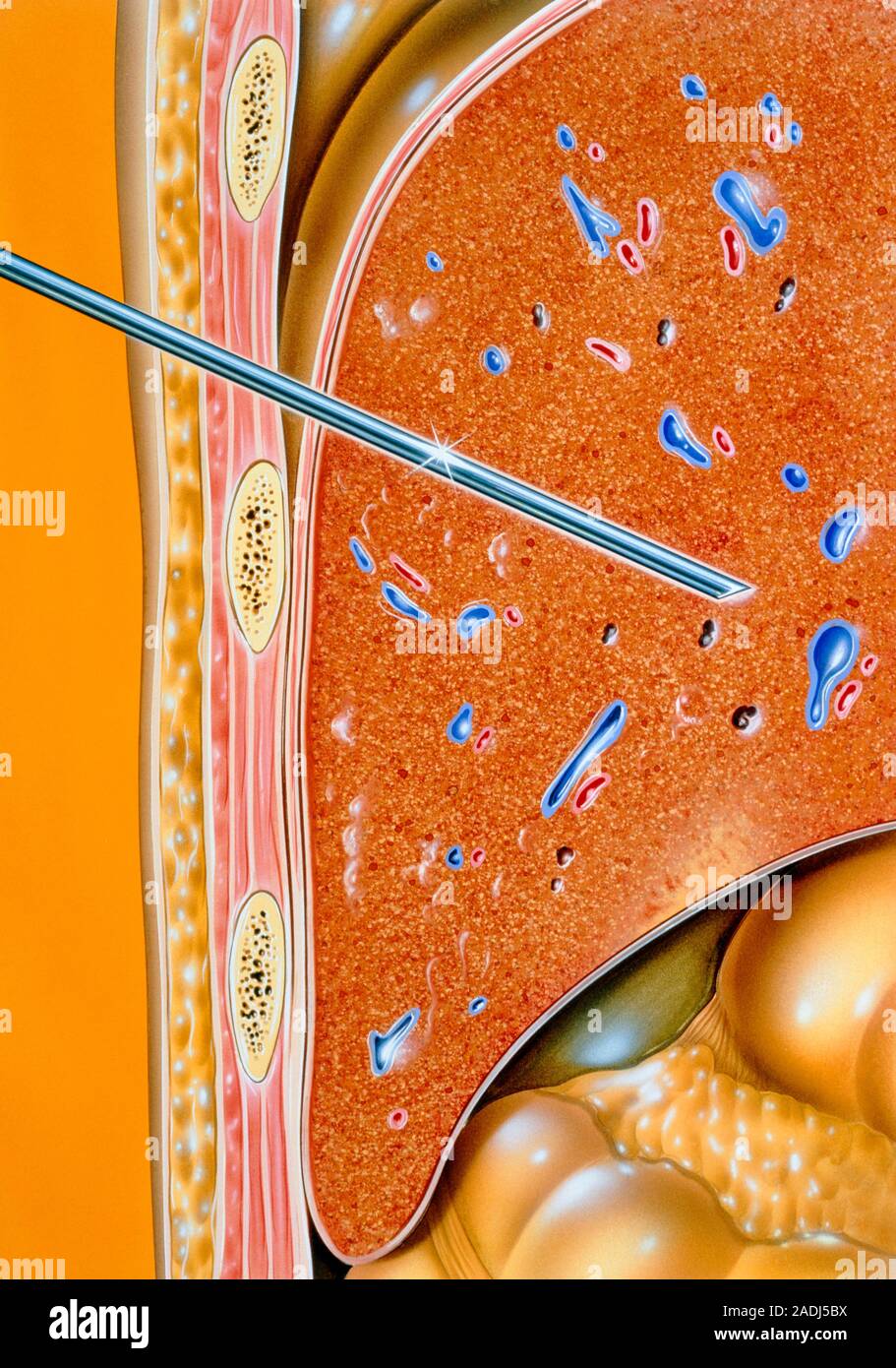 Illustration of liver biopsy procedure by needle. Biopsy is a
