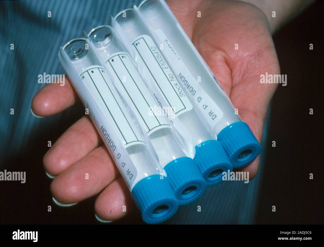 Breath test for stomach ulcer. Sample tubes used for the diagnosis of