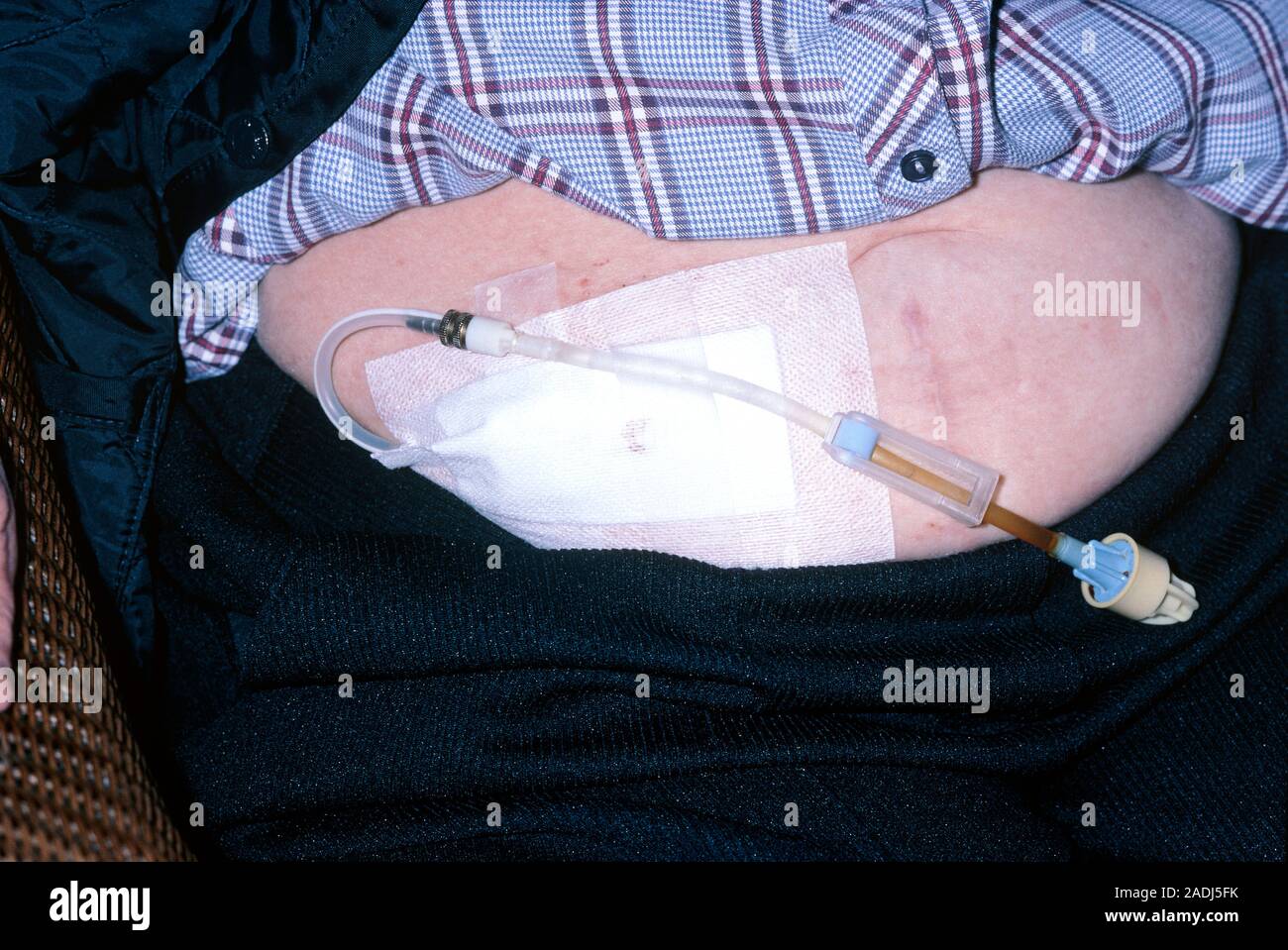 Home dialysis catheter. Close up of the peritoneal catheter of an