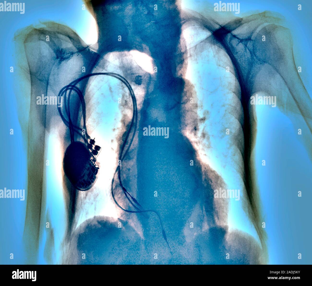 Heart pacemaker. Coloured chest Xray showing a surgicallyimplanted