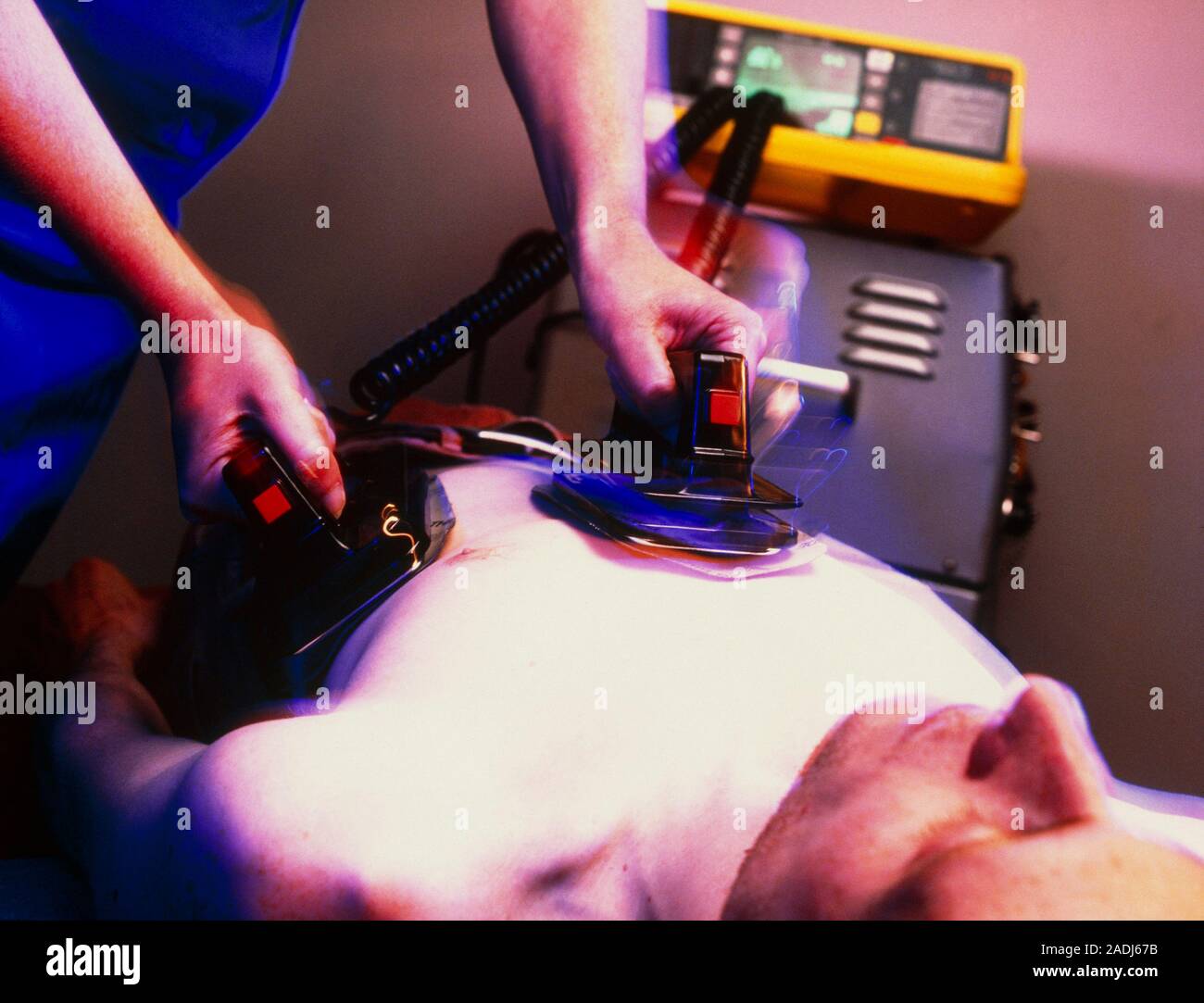 Defibrillation. Man receiving emergency defibrillation to treat a heart ...