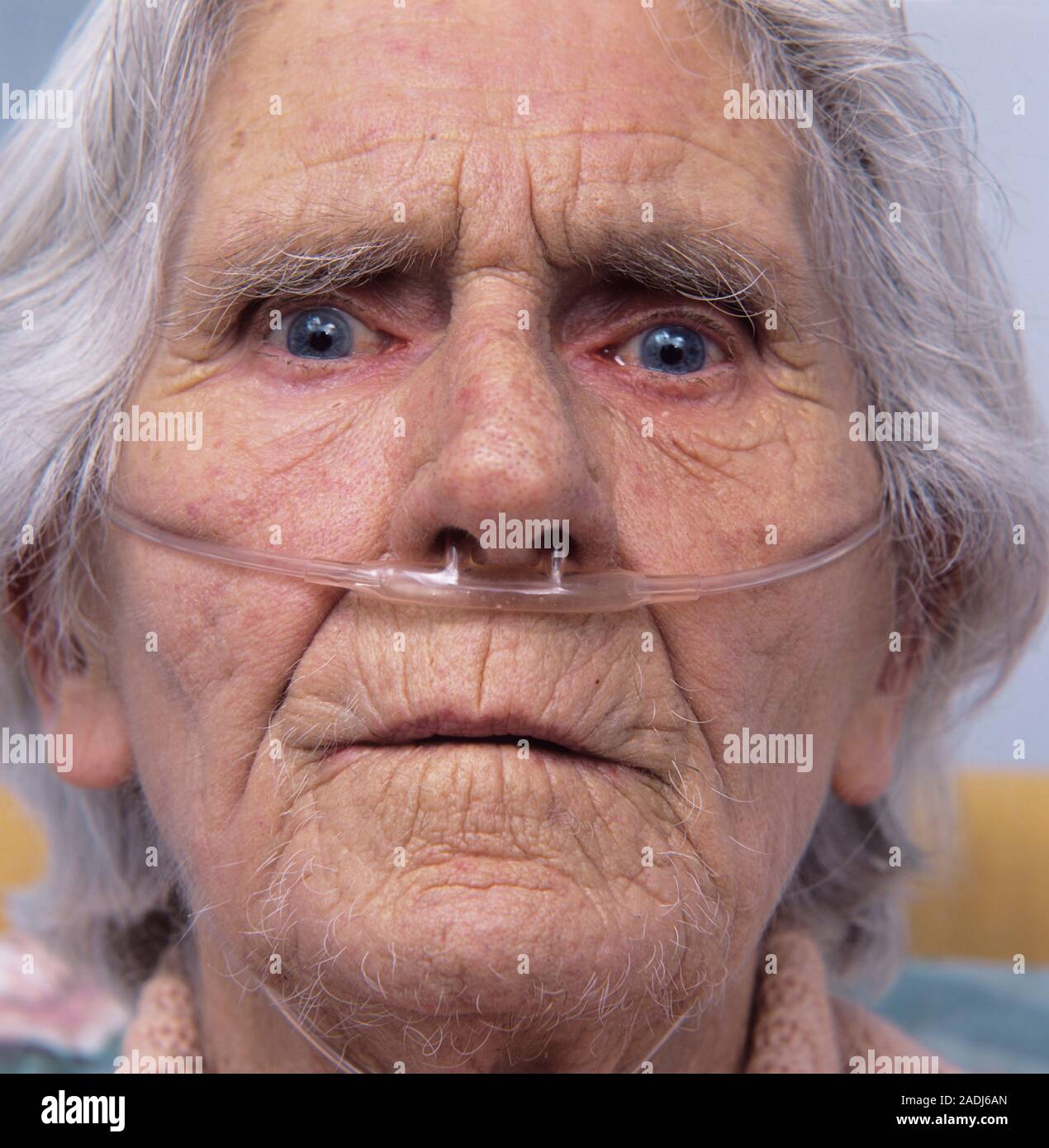 Oxygen therapy. 80yearold woman receiving extra oxygen to help her